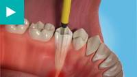 Teeth Whitening