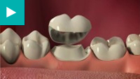 Teeth Whitening