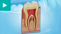 Teeth Whitening
