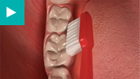 Teeth Whitening