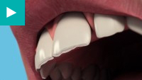 Teeth Whitening