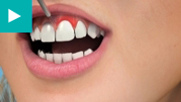 Teeth Whitening