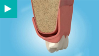 Teeth Whitening