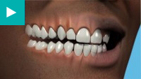 Teeth Whitening
