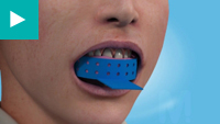 Teeth Whitening