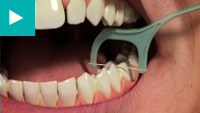 Teeth Whitening